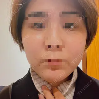 0日目の経過画像（1枚目）