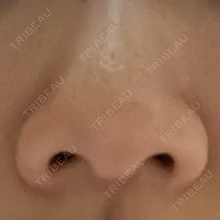 0日目の経過画像（1枚目）
