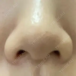 2日目の経過画像（1枚目）