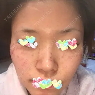 0日目の経過画像（1枚目）