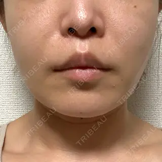30日目の経過画像（1枚目）