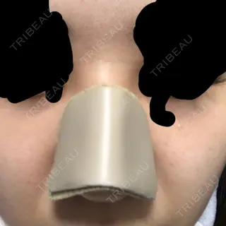 6日目の経過画像（1枚目）