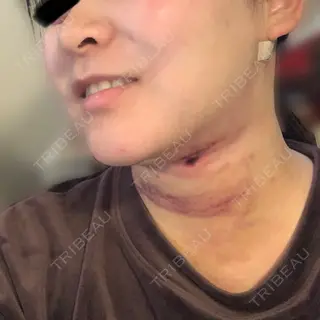 2日目の経過画像（2枚目）