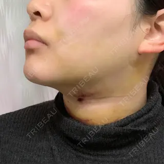 5日目の経過画像（3枚目）