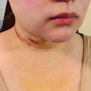 8日目の経過画像（1枚目）