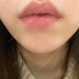 85日目の経過画像（1枚目）