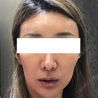 3日目の経過画像（1枚目）