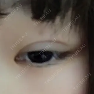 6日目の経過画像（2枚目）