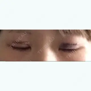 0日目の経過画像（1枚目）