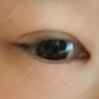 8日目の経過画像（1枚目）