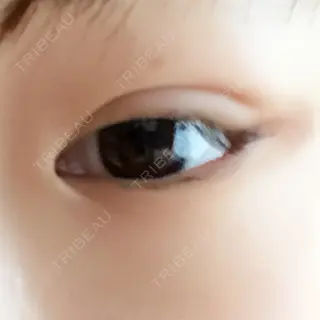 8日目の経過画像（2枚目）