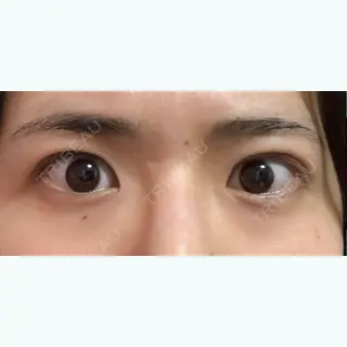 4日目の経過画像（2枚目）