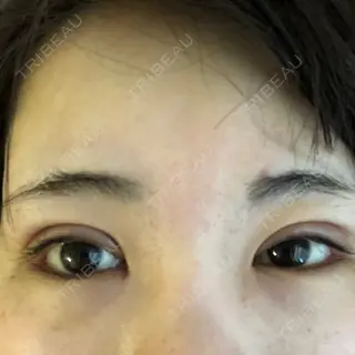 41日目の経過画像（1枚目）