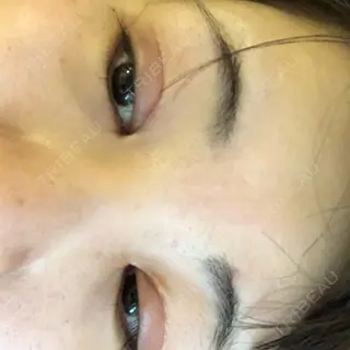 41日目の経過画像（2枚目）