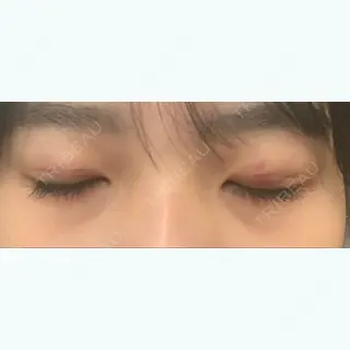 2日目の経過画像（1枚目）