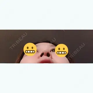 182日目の経過画像（3枚目）