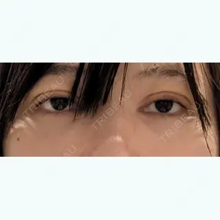 4日目の経過画像（2枚目）