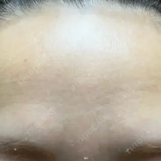 1日目の経過画像（1枚目）
