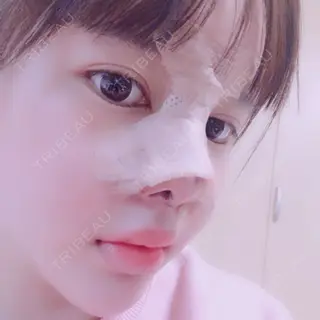 5日目の経過画像（2枚目）
