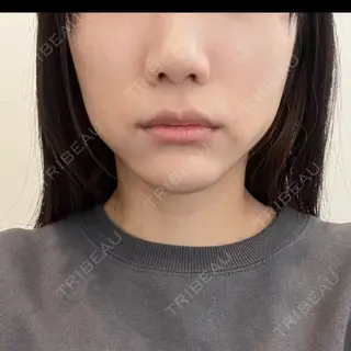 3日目の経過画像（1枚目）