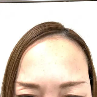 3日目の経過画像（1枚目）