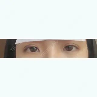 3日目の経過画像（1枚目）