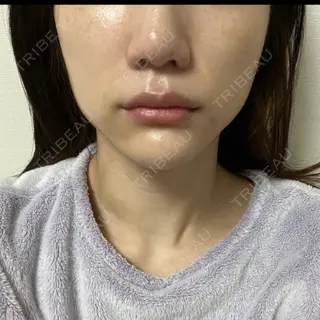 5日目の経過画像（1枚目）
