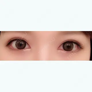 35日目の経過画像（1枚目）