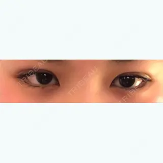 0日目の経過画像（1枚目）