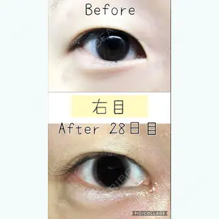 28日目の経過画像（2枚目）