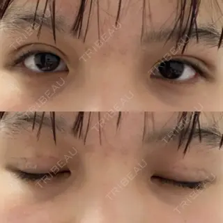 8日目の経過画像（1枚目）