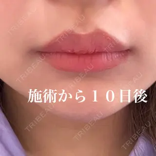 0日目の経過画像（1枚目）