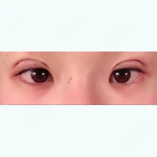 0日目の経過画像（1枚目）