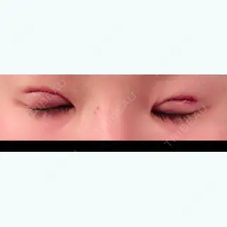 0日目の経過画像（2枚目）
