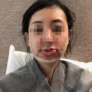 4日目の経過画像（1枚目）