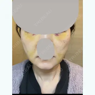 6日目の経過画像（1枚目）