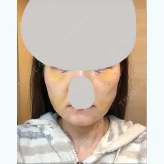 7日目の経過画像（1枚目）