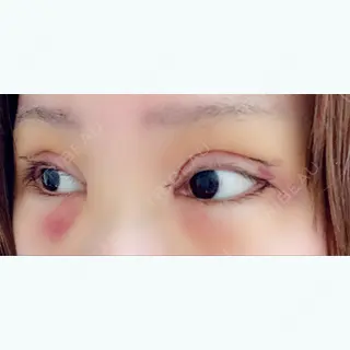 4日目の経過画像（2枚目）