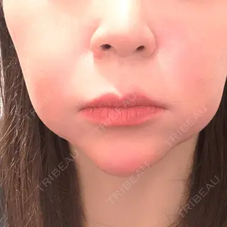 0日目の経過画像（1枚目）