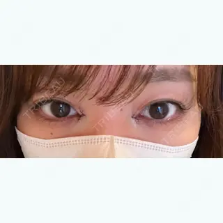 0日目の経過画像（1枚目）