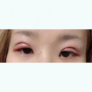 1日目の経過画像（1枚目）