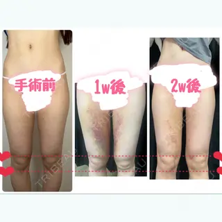 14日目の経過画像（1枚目）