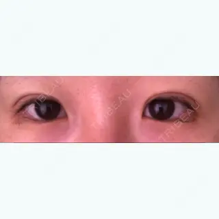 0日目の経過画像（3枚目）