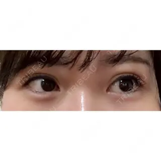 16日目の経過画像（2枚目）