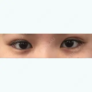 3日目の経過画像（1枚目）