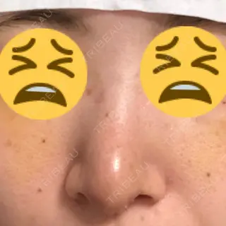 6日目の経過画像（1枚目）