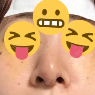 6日目の経過画像（2枚目）