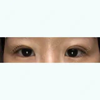 1日目の経過画像（2枚目）