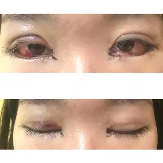 2日目の経過画像（1枚目）
