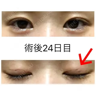 23日目の経過画像（1枚目）
